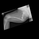 Alime right femur lat