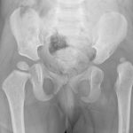 Hip dislocation